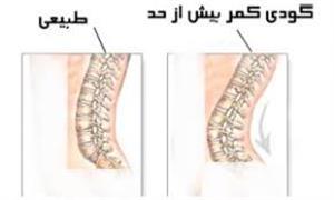 علت گودی کمر چیست؟ علت گودی کمر چیست؟
